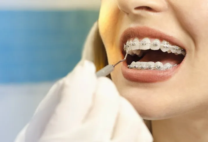 Orthodontic Implants